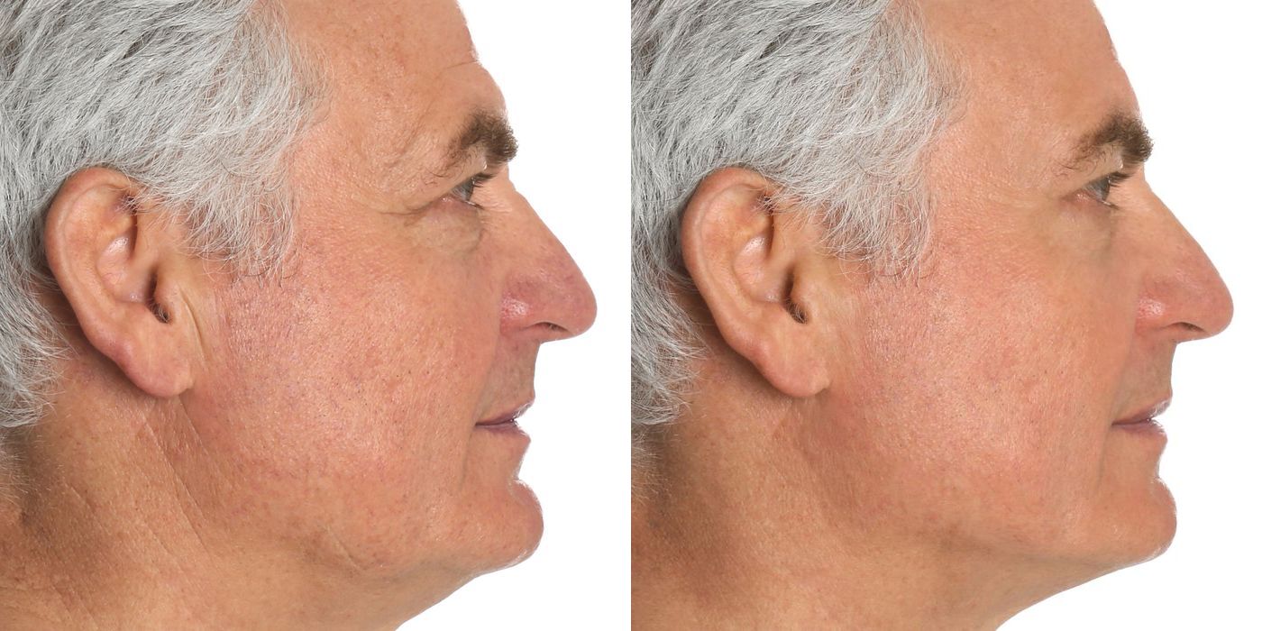 BOTOX Cosmetic - Thumbnail 3