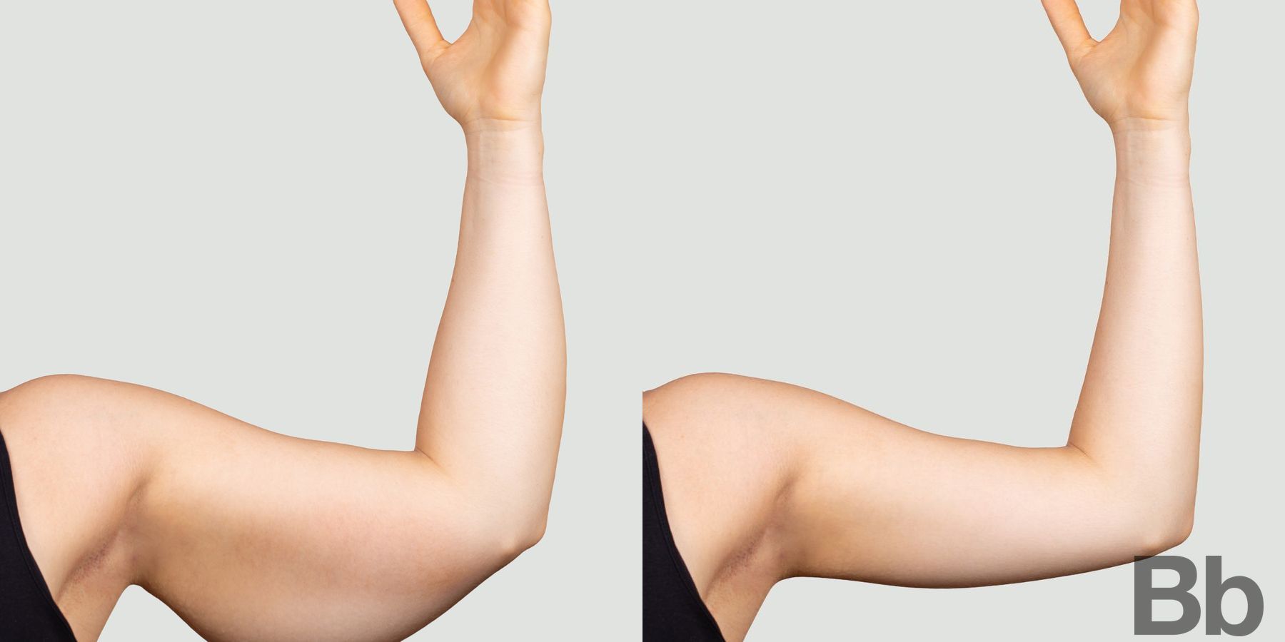 Before and after Arm Lift case 4743