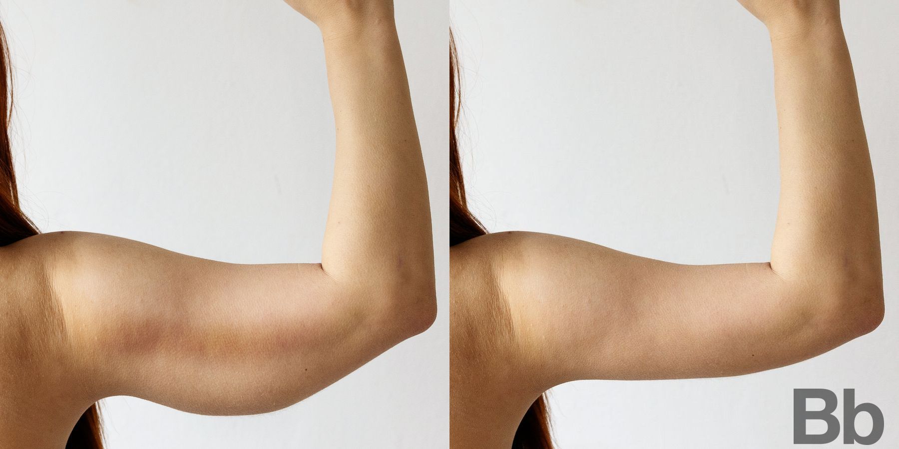Before and after Arm Lift case 4744