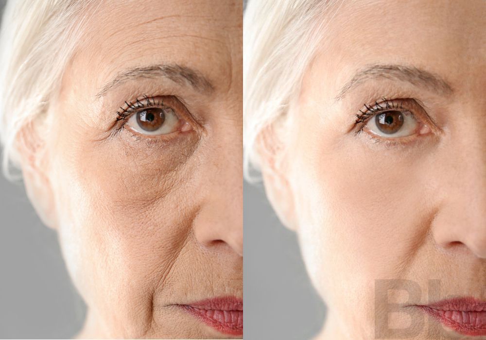 BOTOX Cosmetic - Case 78