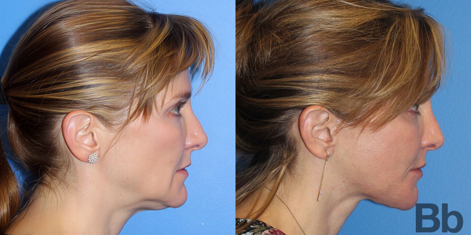Before and after Facelift case 21711 - Angle 3
