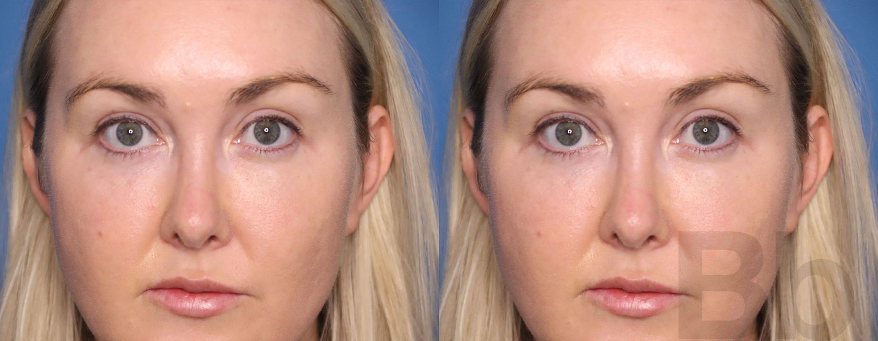 BOTOX Cosmetic - Thumbnail 2