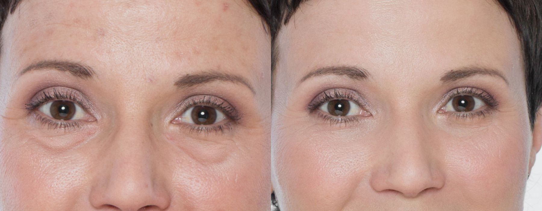 Before and after BOTOX Cosmetic case 12303