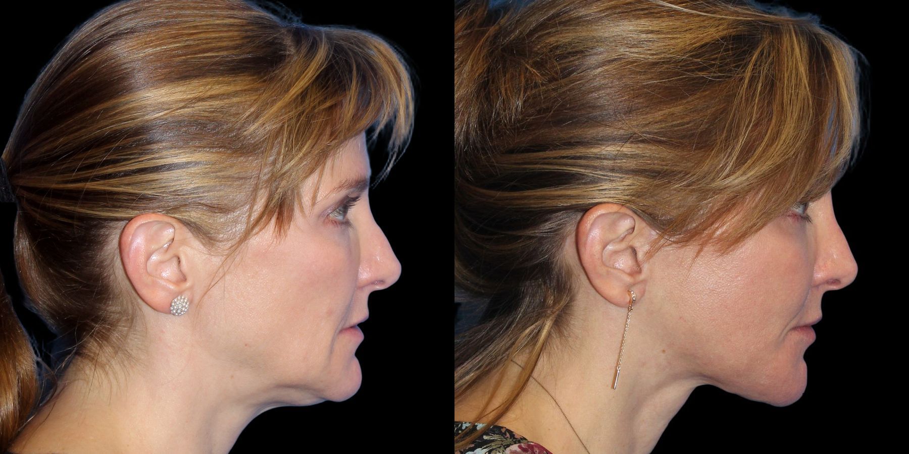 Before and after Facelift case 21711