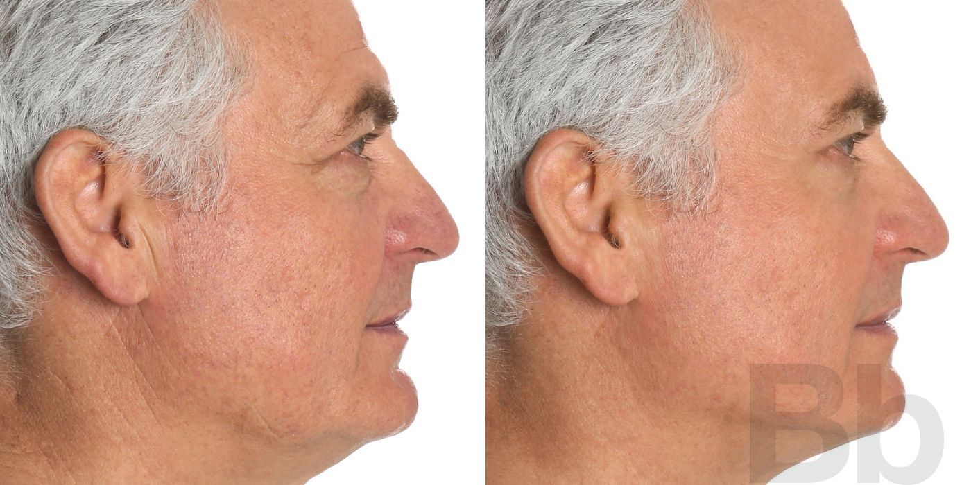 Facelift - Thumbnail 2