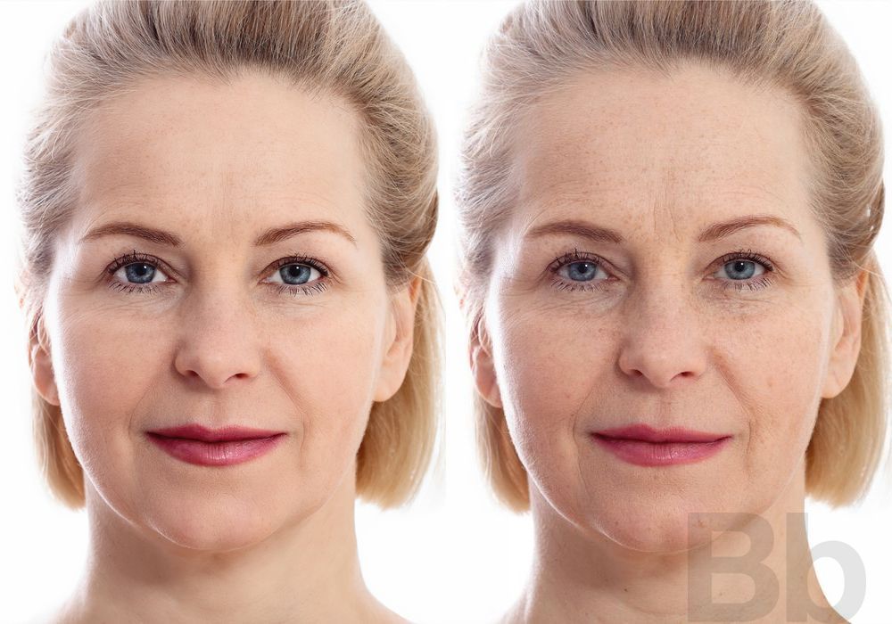 BOTOX Cosmetic - Case 90