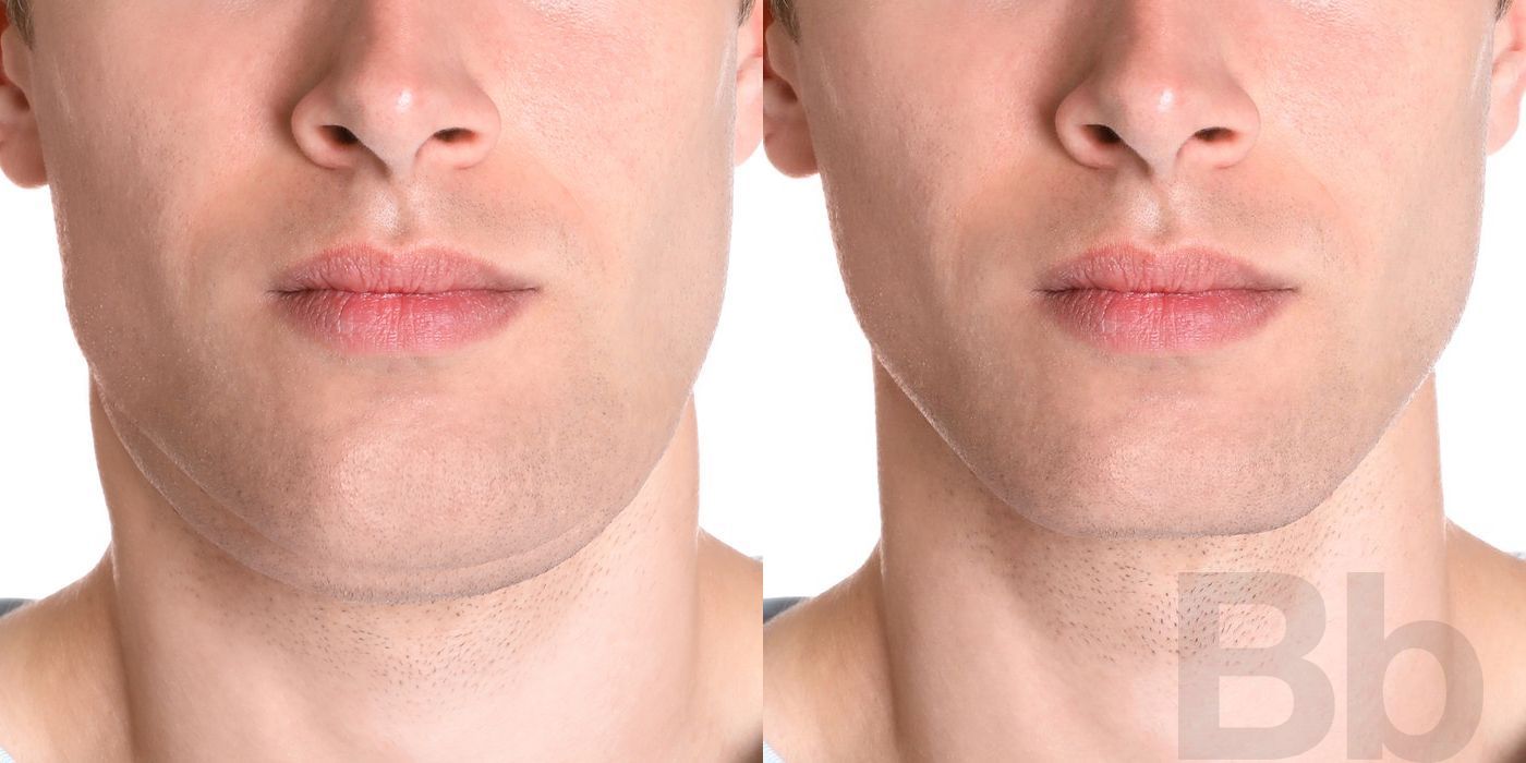 Hair Loss Treatment - Case 123