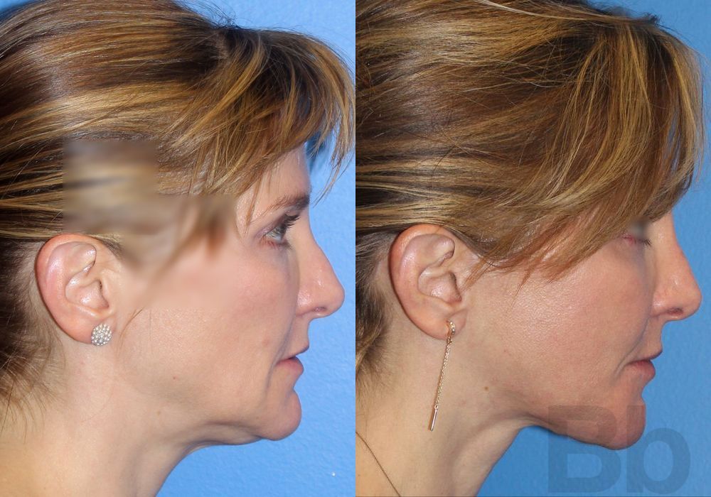 Laser Skin Resurfacing - Thumbnail 3