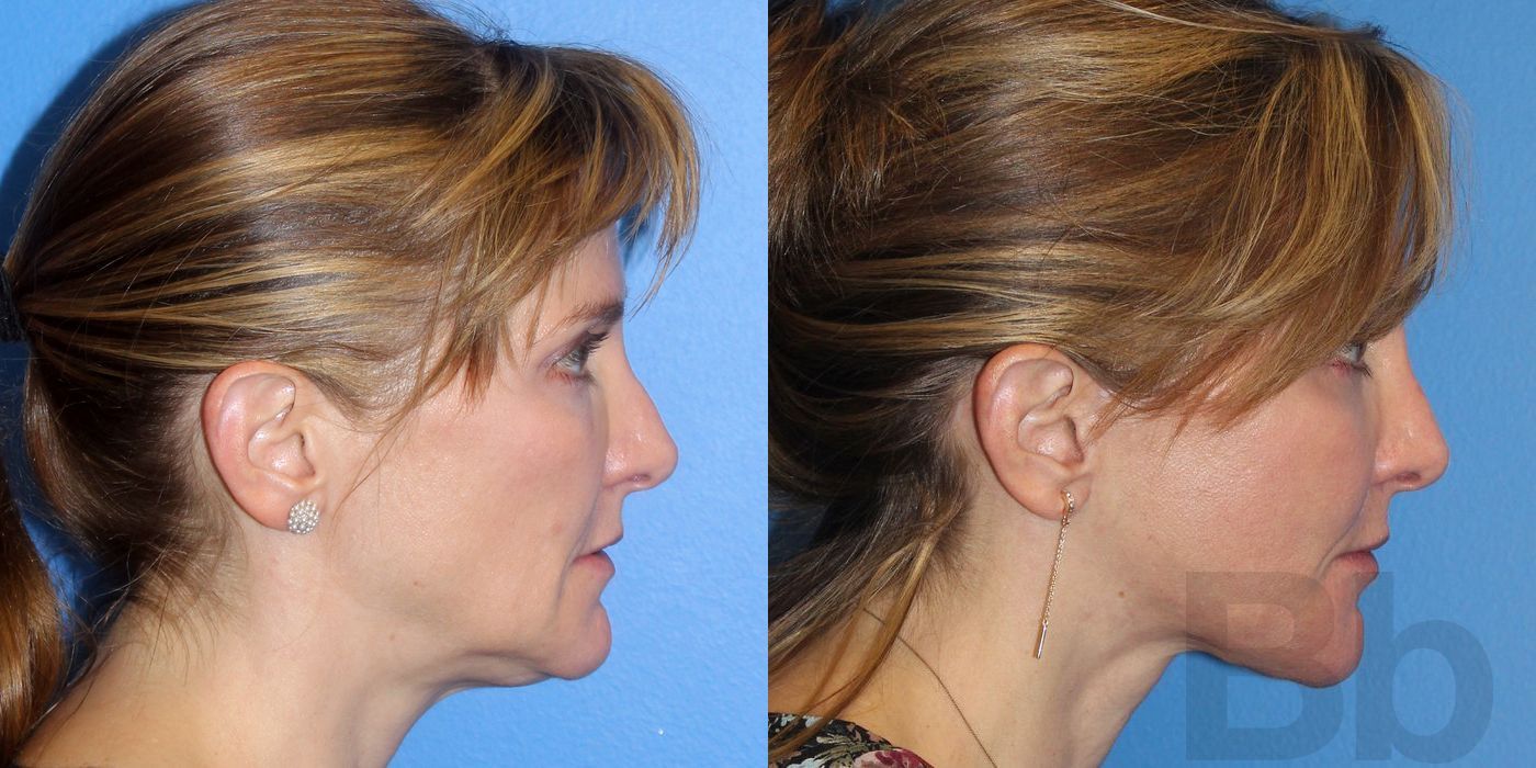 Laser Skin Resurfacing - Case 136