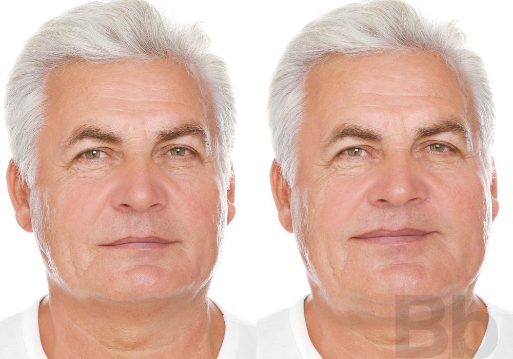 Blepharoplasty - Case 72