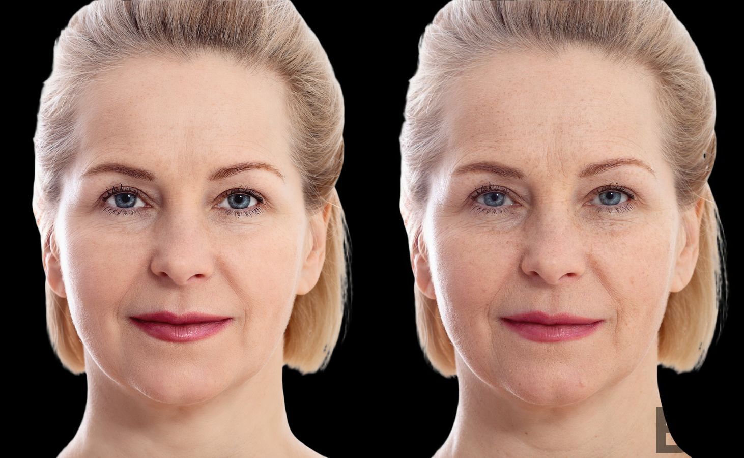 Before and after BOTOX Cosmetic case 23827