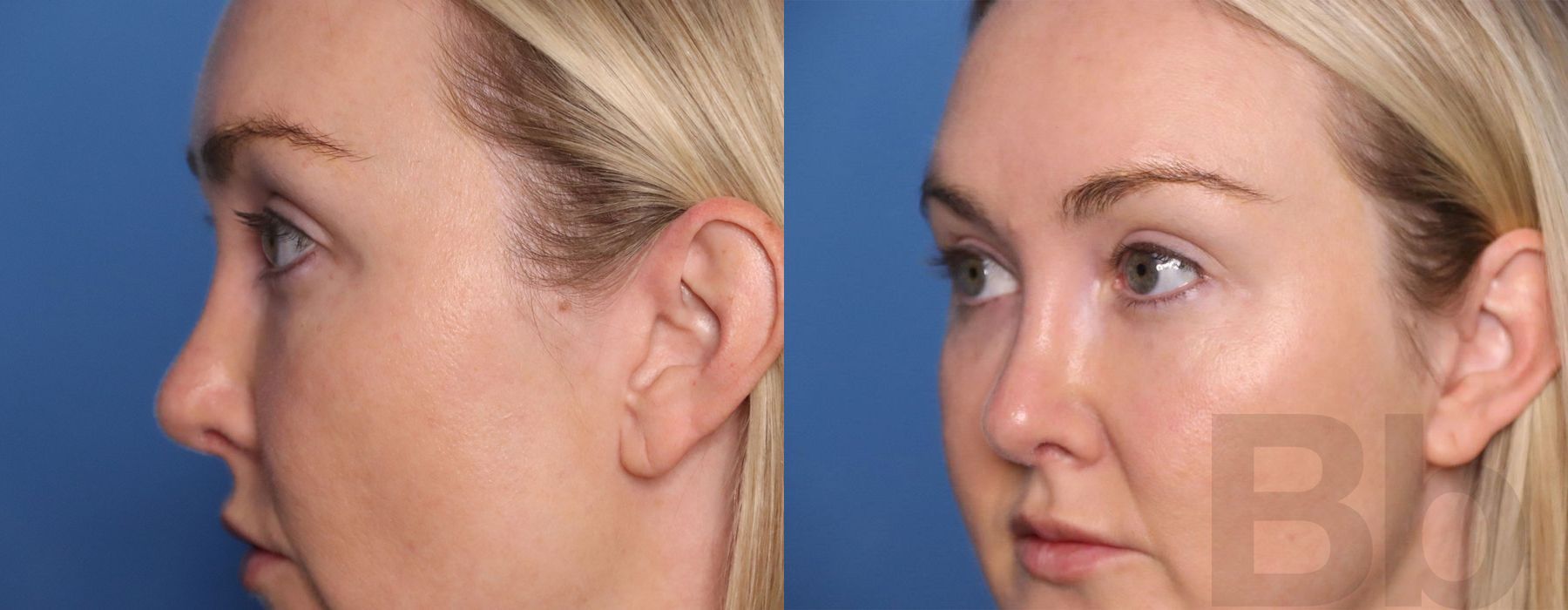 BOTOX Cosmetic - Case 87