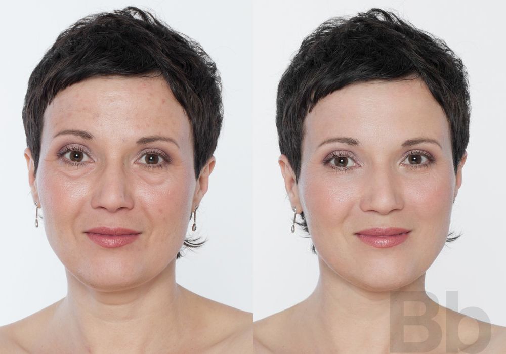 BOTOX Cosmetic - Case 84