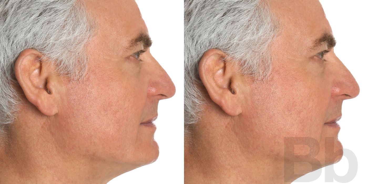 Top Surgery - Feminization - Thumbnail 2