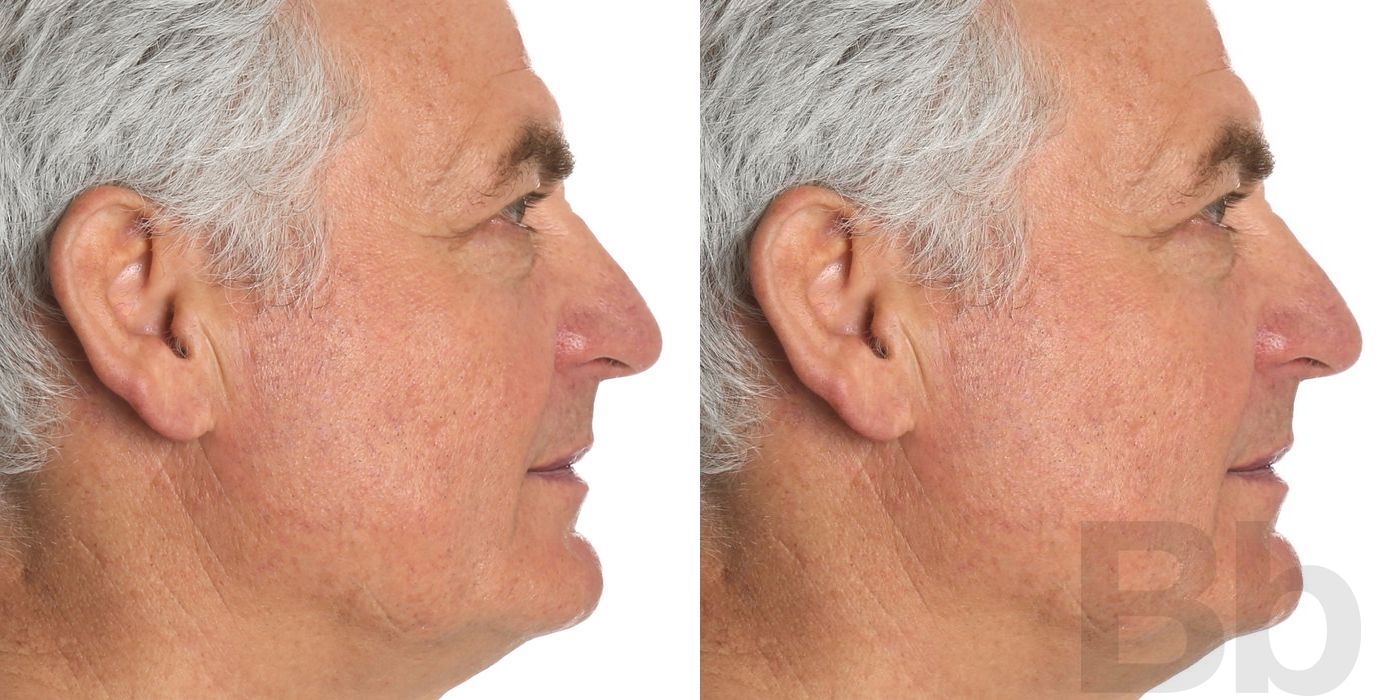 Top Surgery - Feminization - Thumbnail 3