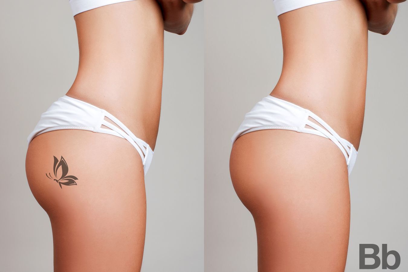 Before and after Brazilian Butt Lift case 17180