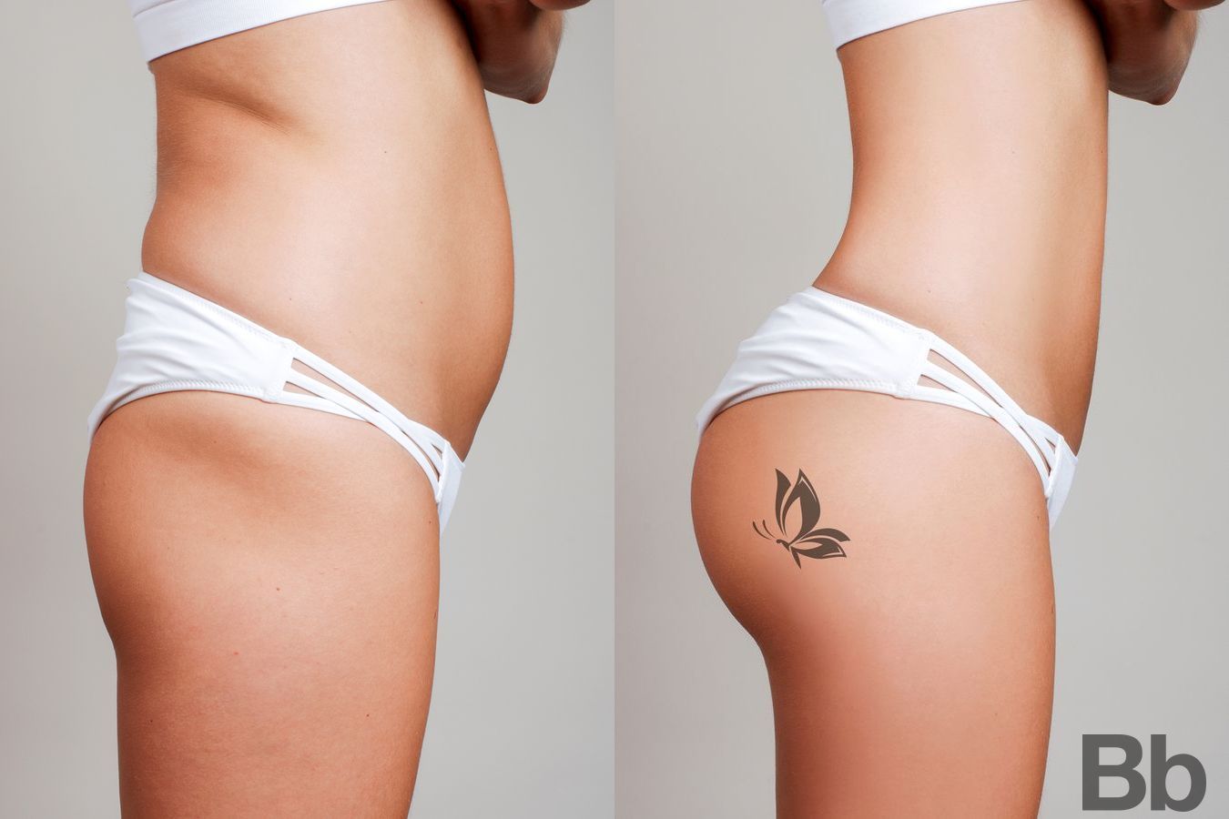 Before and after Brazilian Butt Lift case 16840