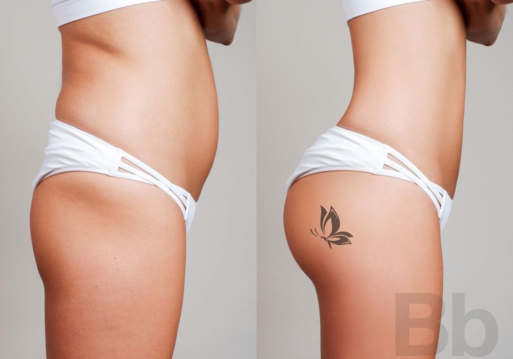 Brazilian Butt Lift - Case 12