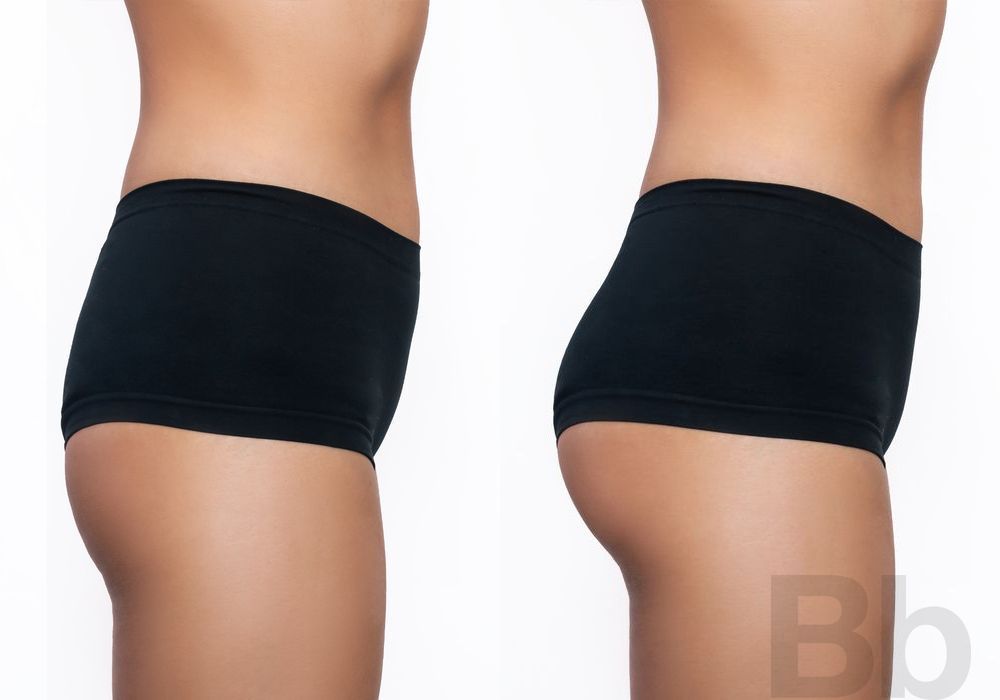 Brazilian Butt Lift - Case 11