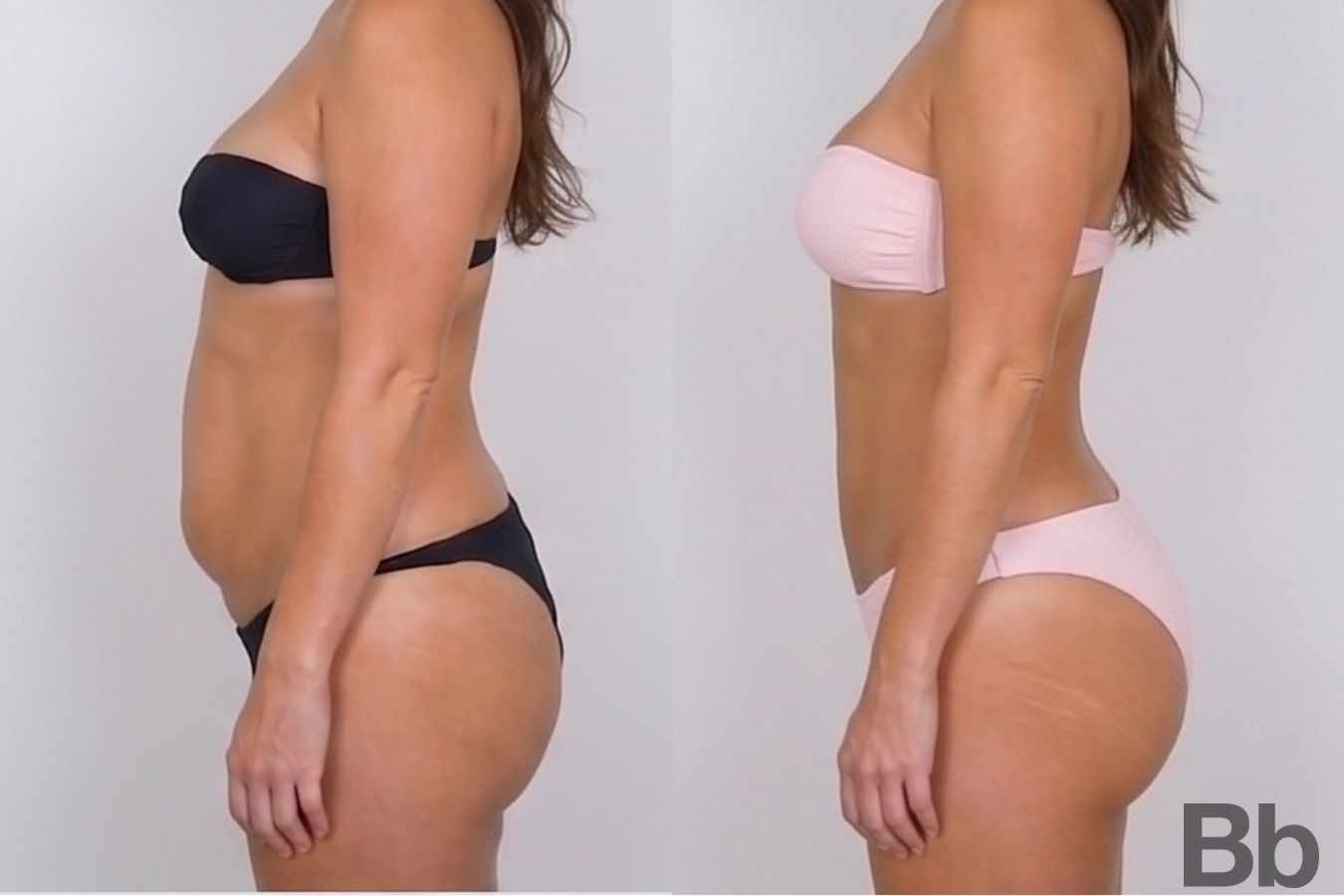 Before and after Tummy Tuck case 43134 - Angle 2