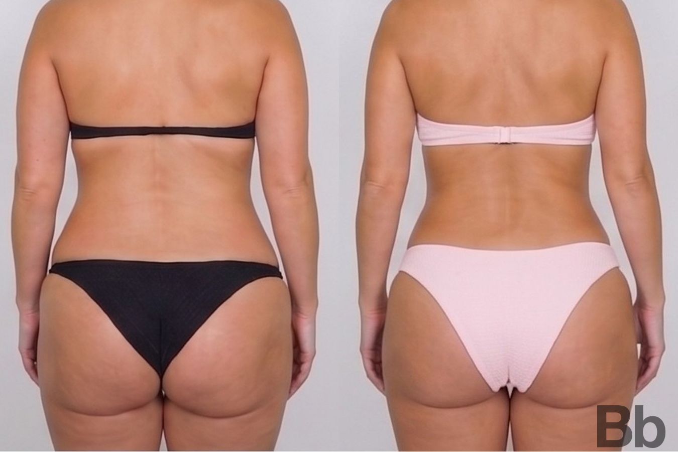 Before and after Tummy Tuck case 43134 - Angle 3