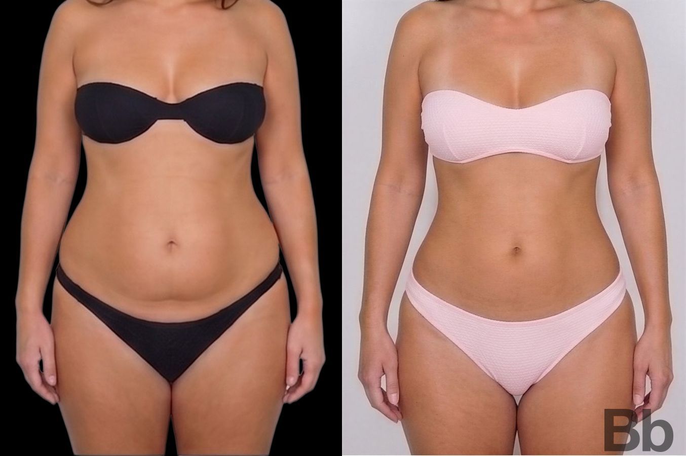 Before and after Tummy Tuck case 43134