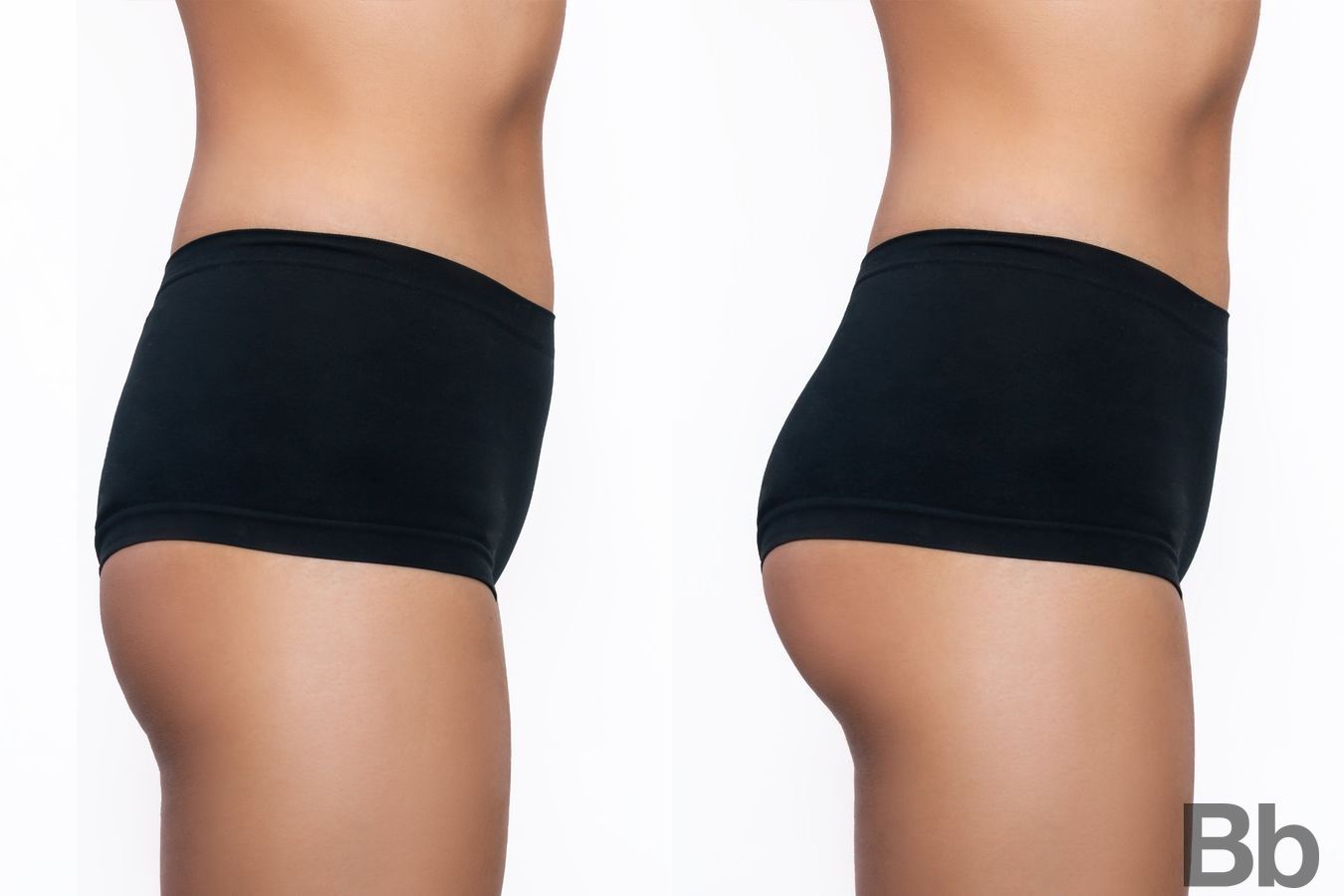 Before and after Brazilian Butt Lift case 4786