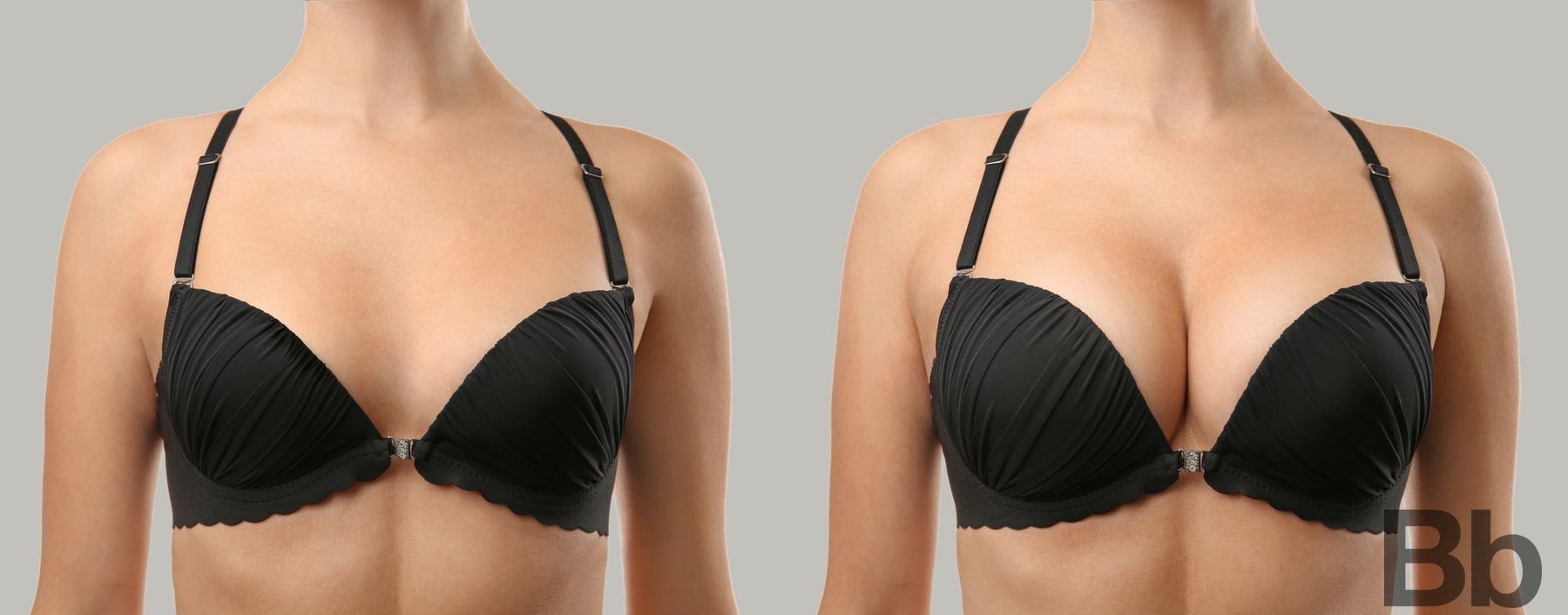 Before and after Breast Augmentation case 10986 - Angle 2
