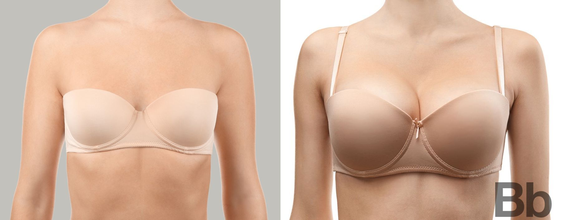 Before and after Breast Augmentation case 10984