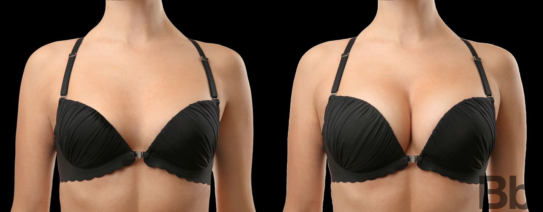 Before and after Breast Augmentation case 23842 - Angle 2