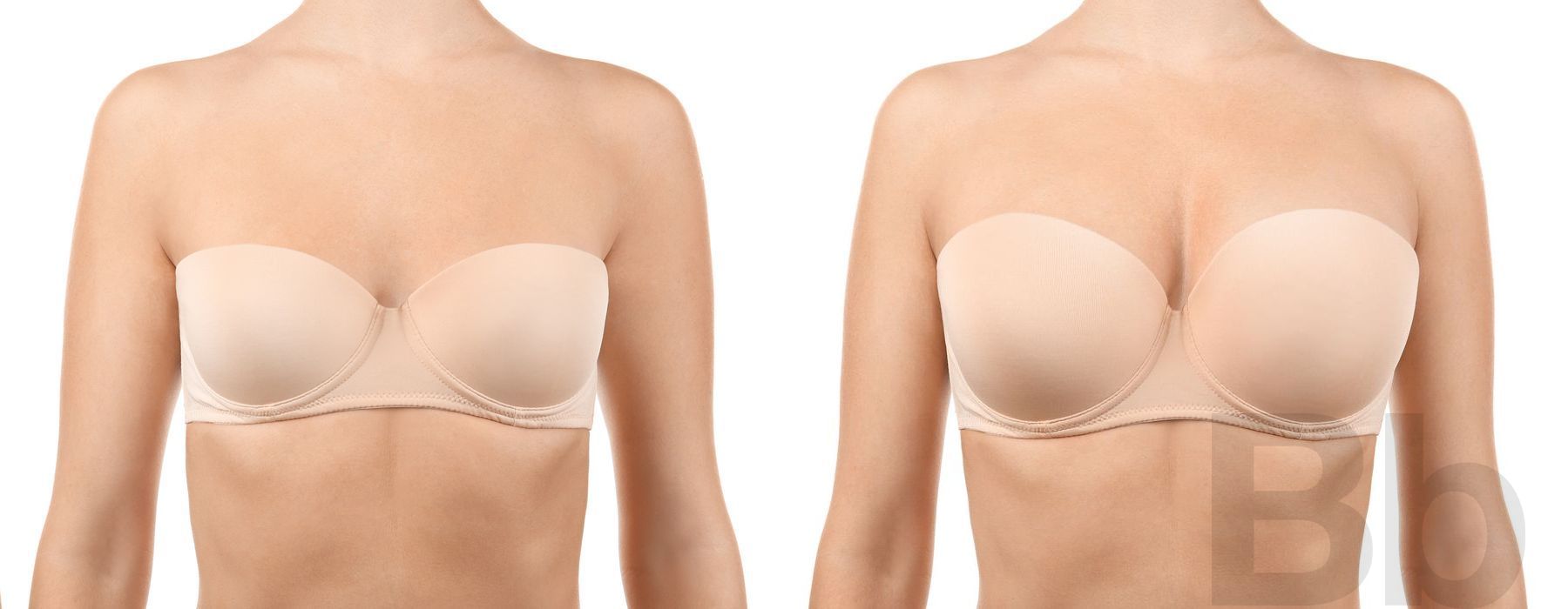 Breast Augmentation - Case 53