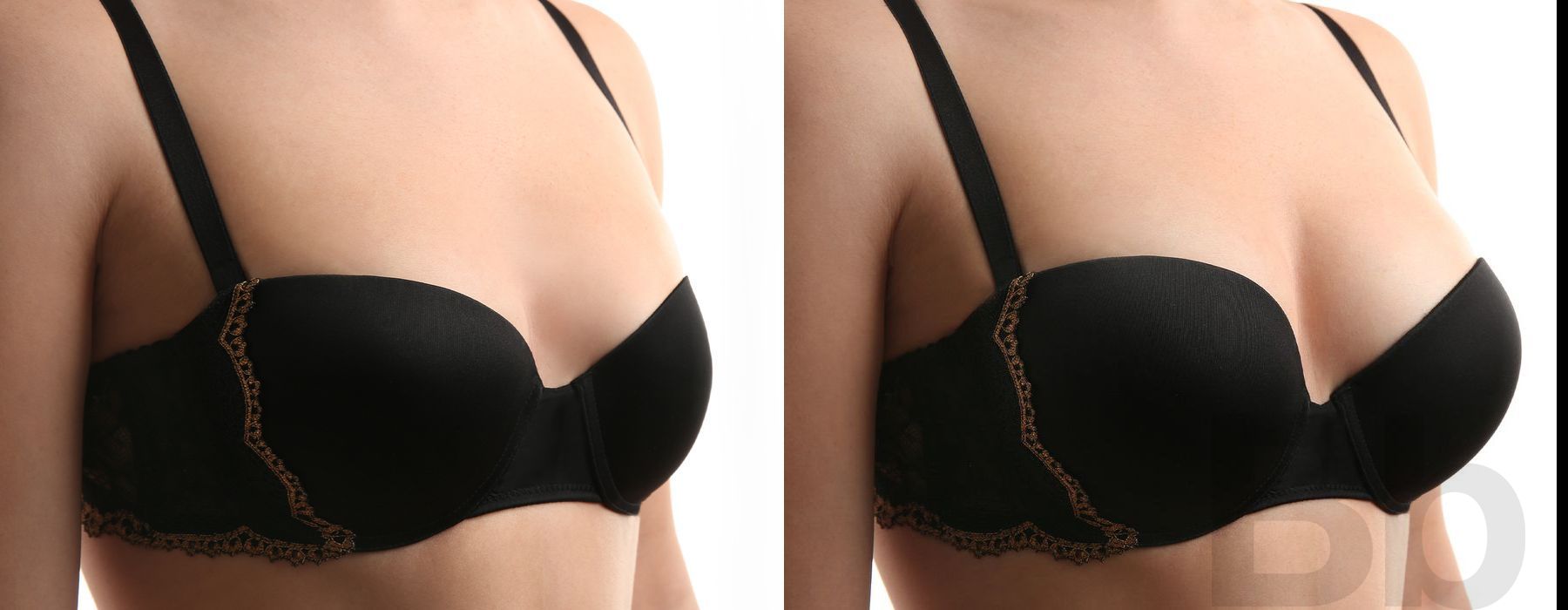 Breast Augmentation - Case 54