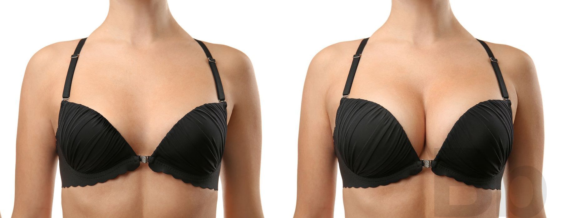 Breast Augmentation - Thumbnail 3