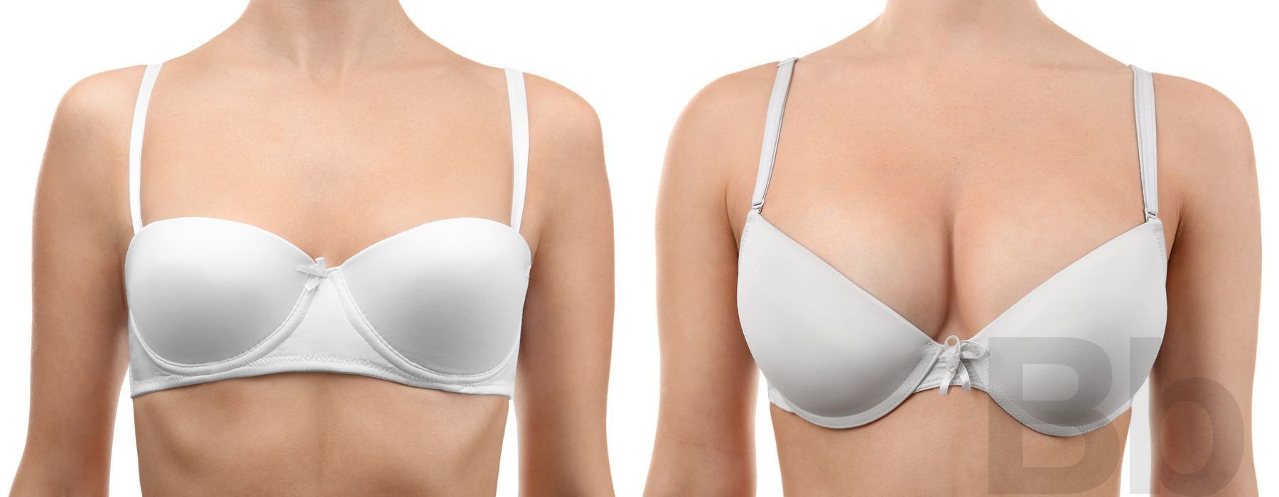 Breast Augmentation - Case 50