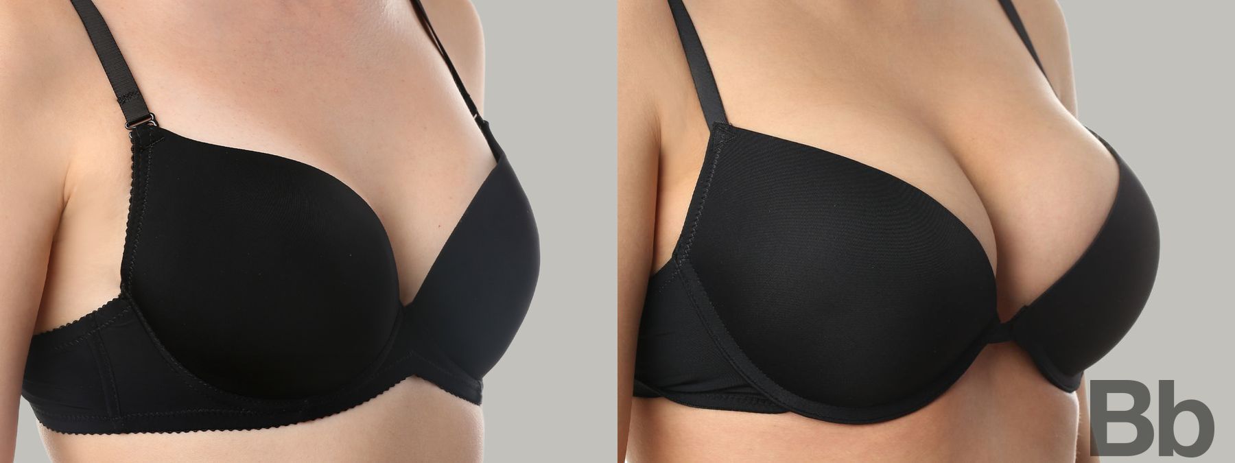 Before and after Breast Augmentation case 6982