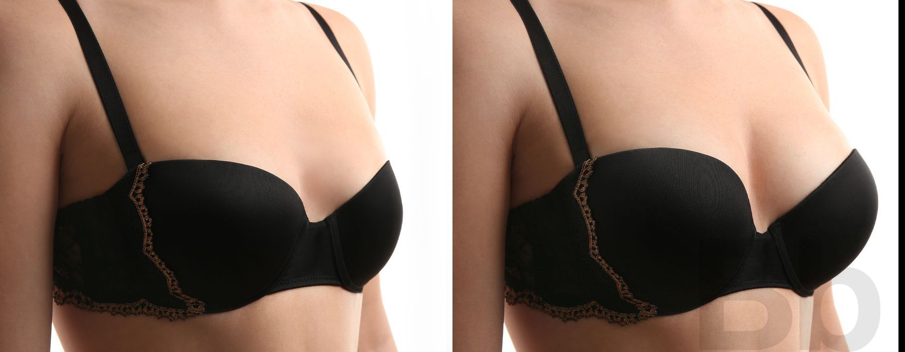 Breast Lift - Case 18