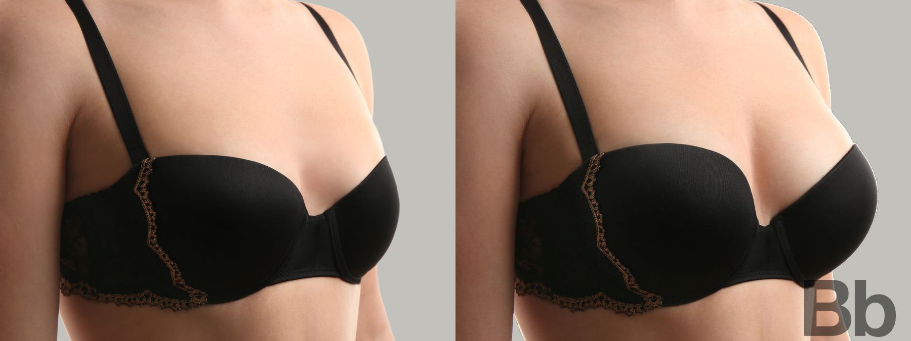 Before and after Breast Augmentation case 4781
