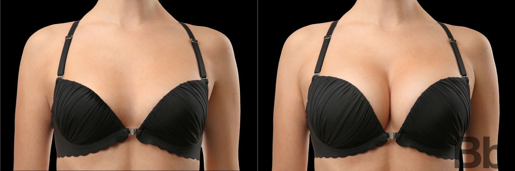 Before and after Breast Augmentation case 23842