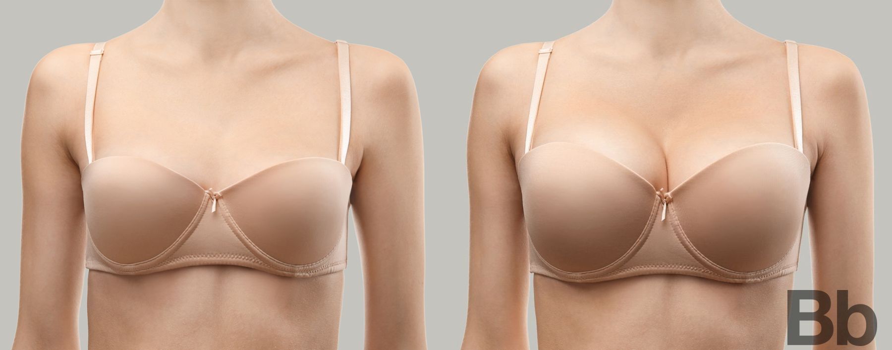 Before and after Breast Augmentation case 4785