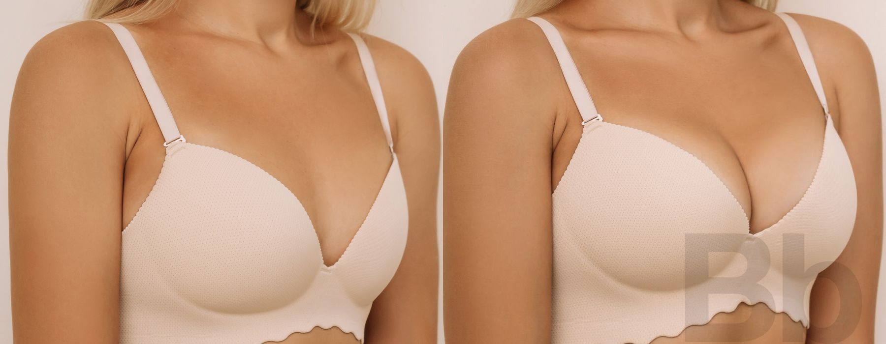 Breast Lift - Thumbnail 2