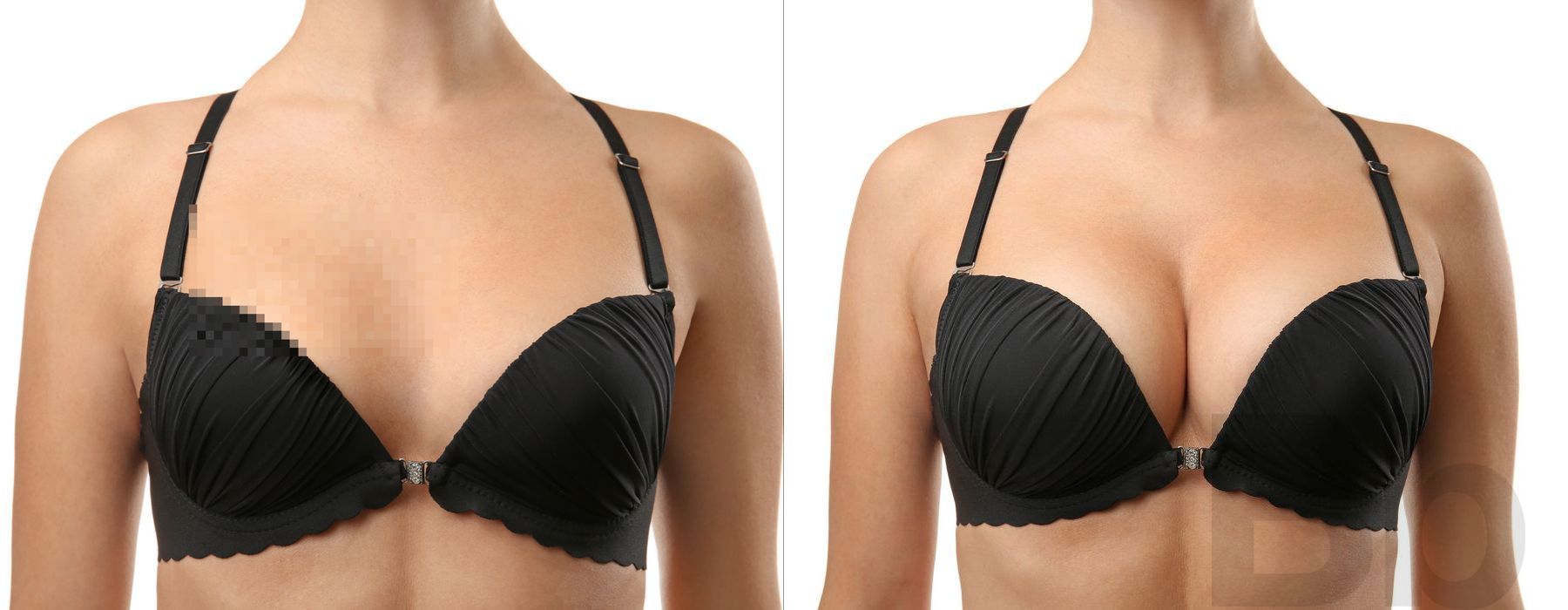 Mommy Makeover - Case 1696