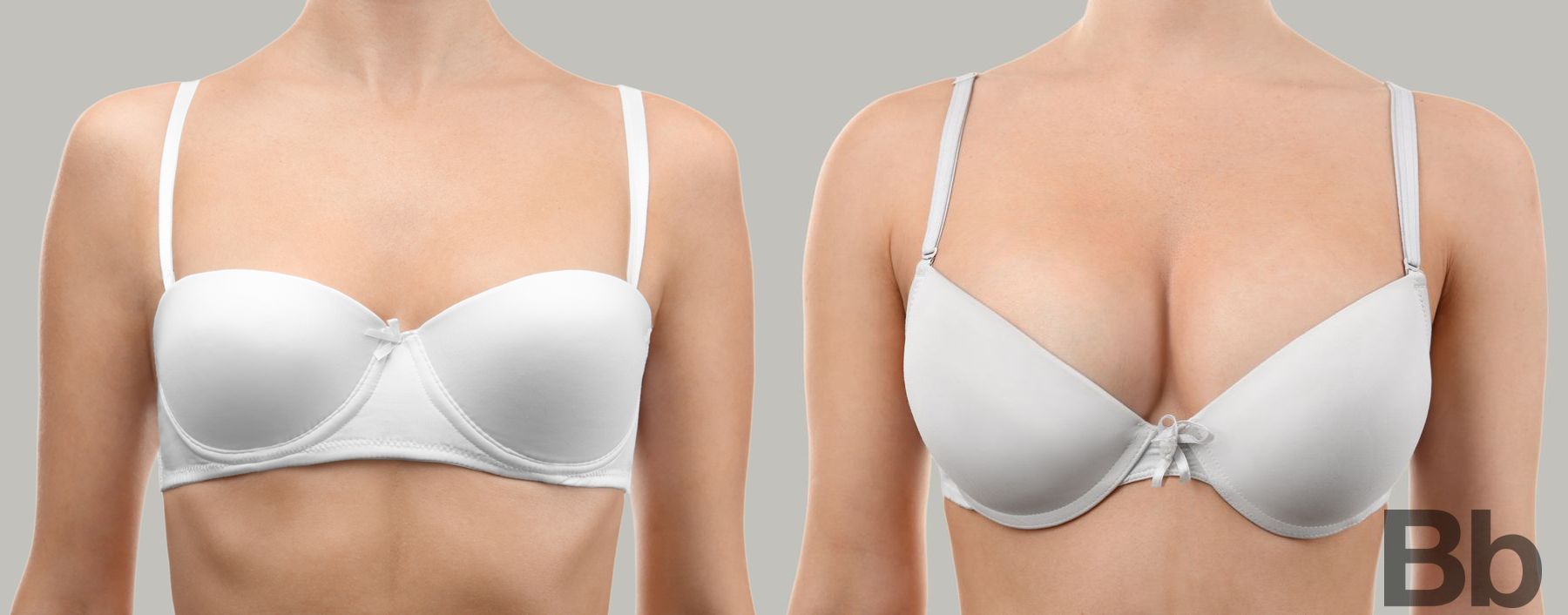 Before and after Breast Augmentation case 4784