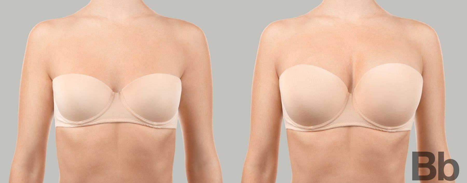 Before and after Breast Augmentation case 4782