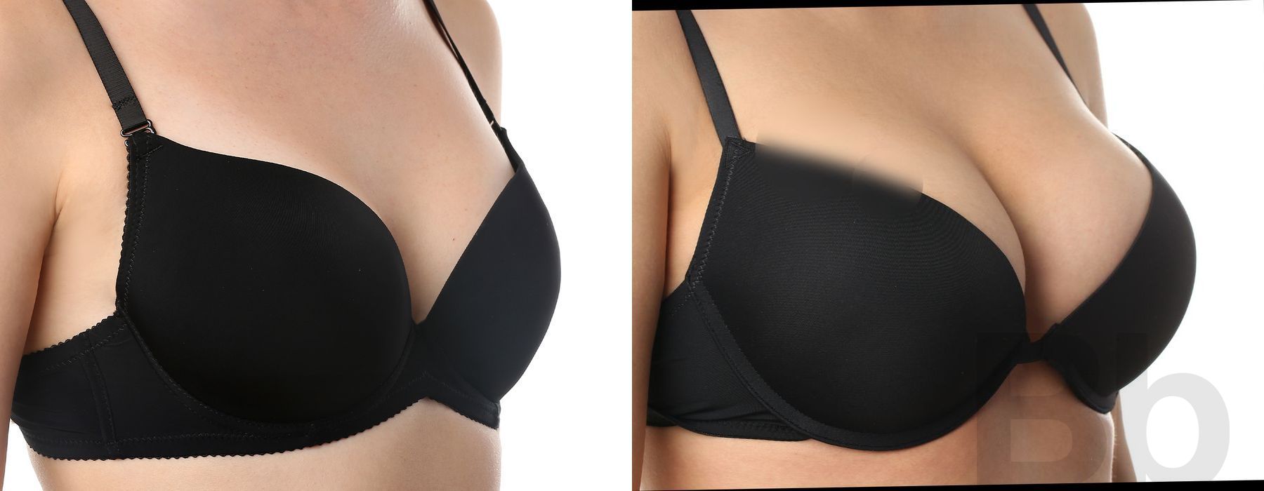 Breast Augmentation - Thumbnail 2