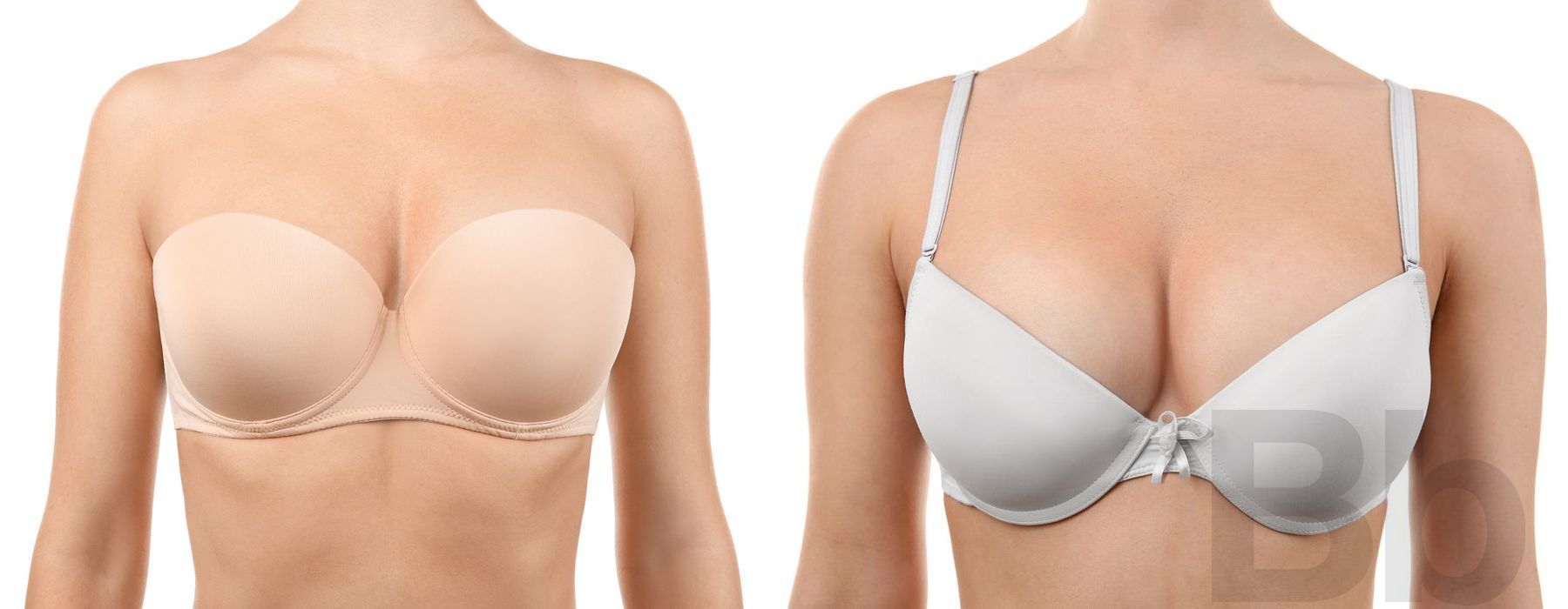 Tummy Tuck - Case 45