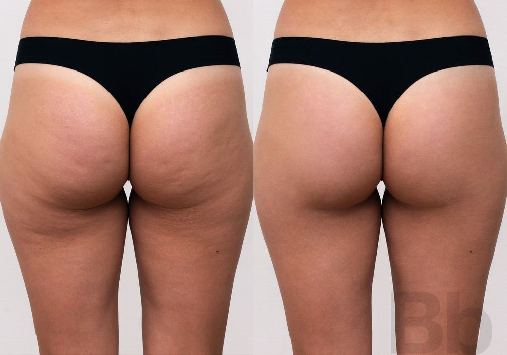 Cellulite Reduction - Case 153