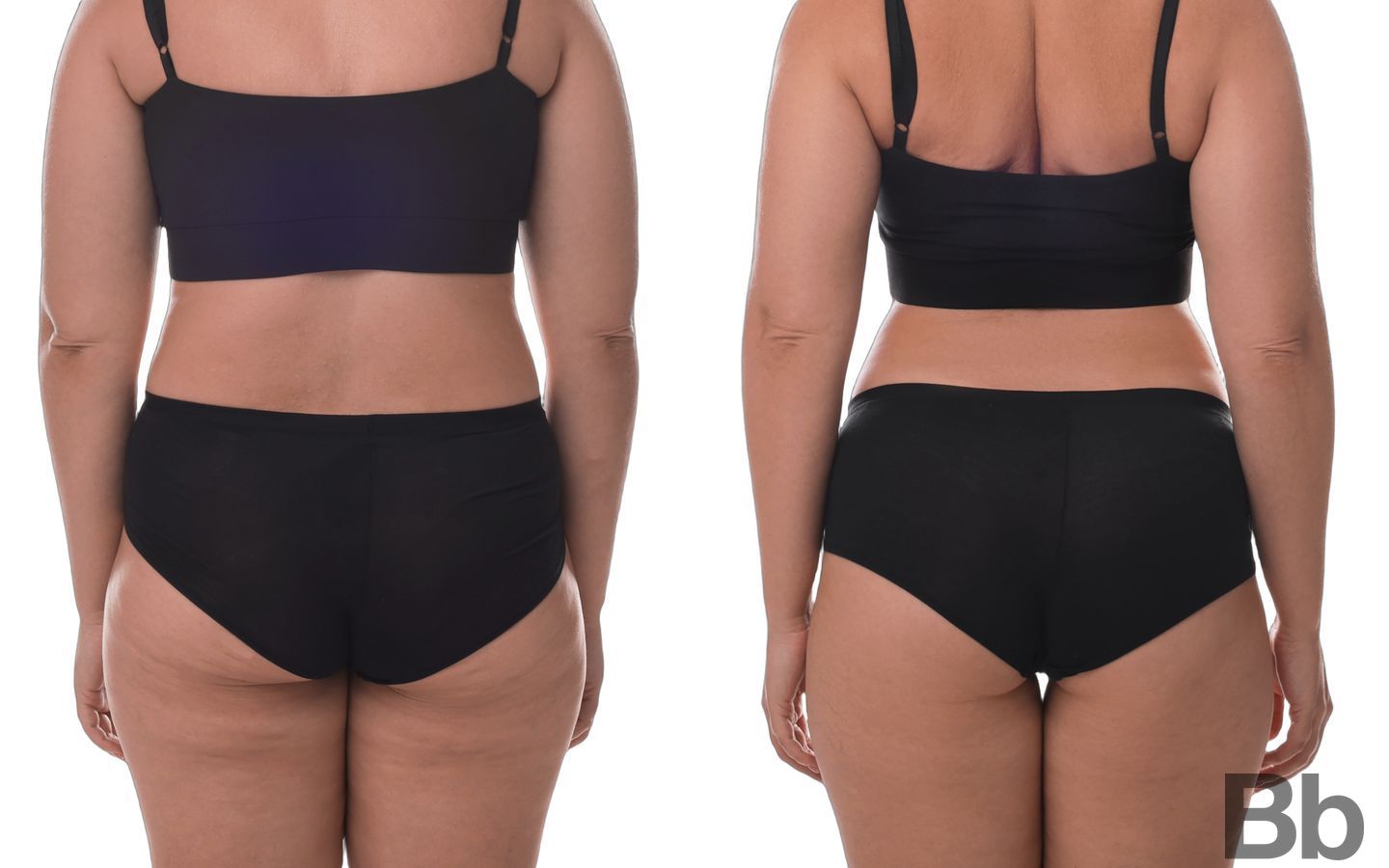 Before and after Liposuction case 43119 - Angle 2