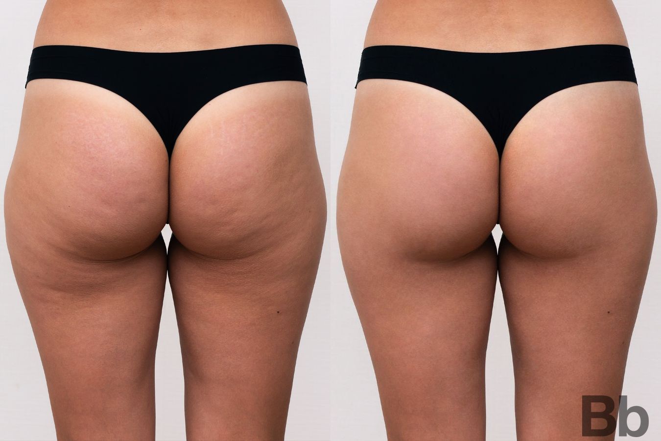 Before and after Cellulite Reduction case 4760