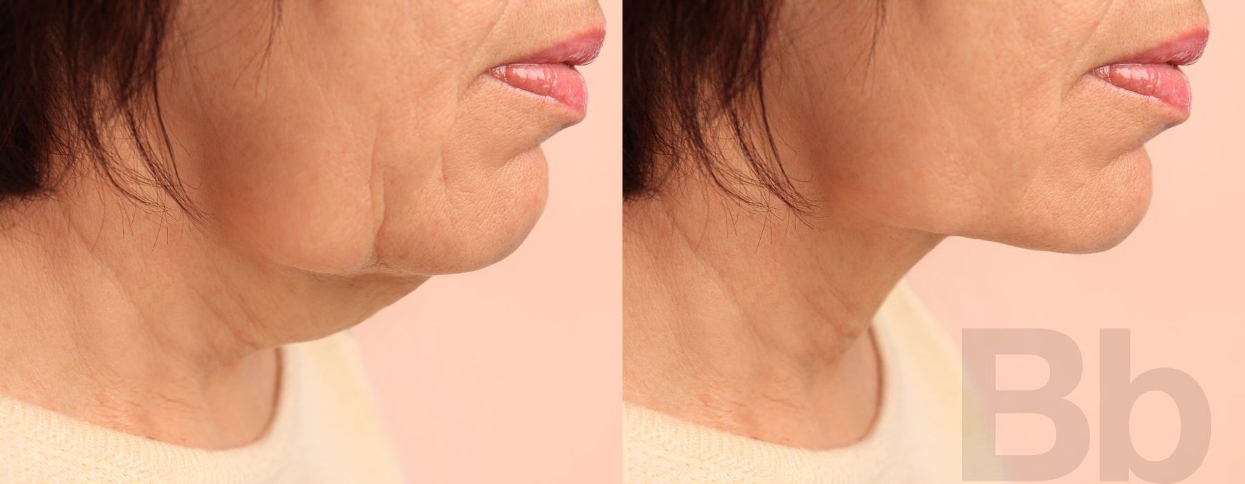 Chin Augmentation - Case 101