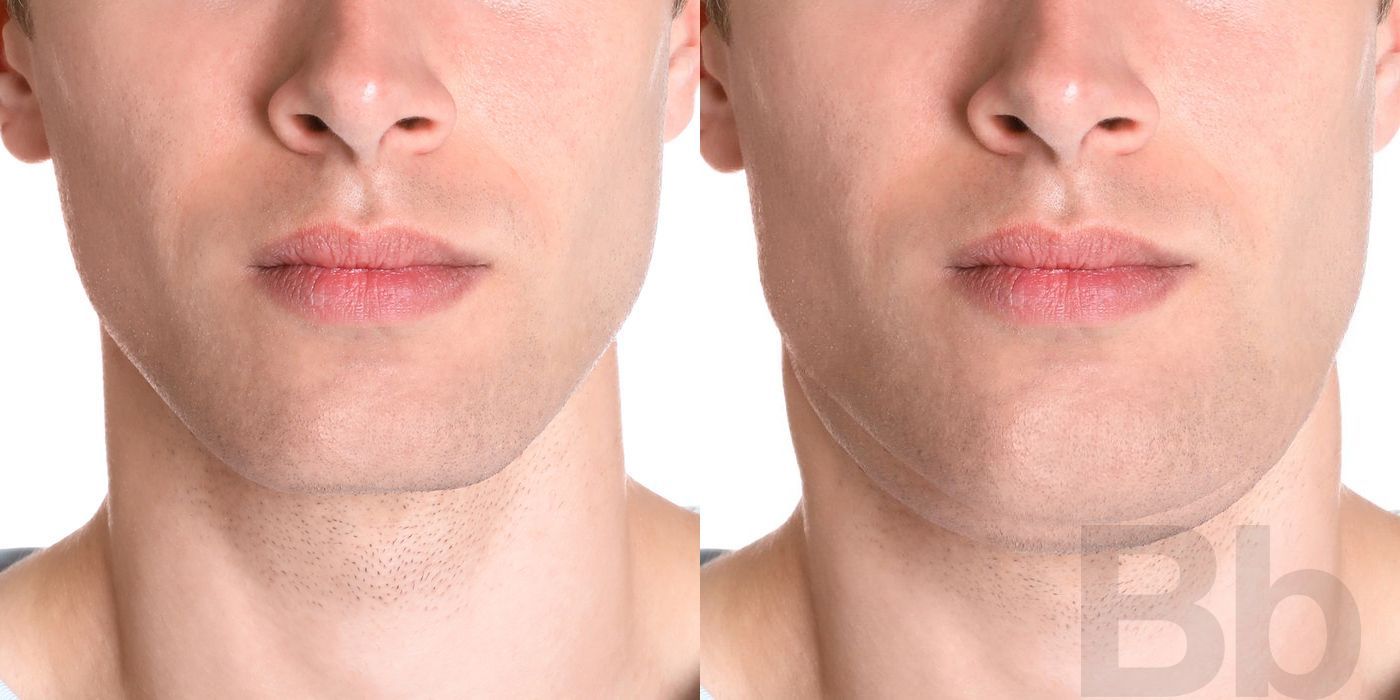 Chin Augmentation - Case 102